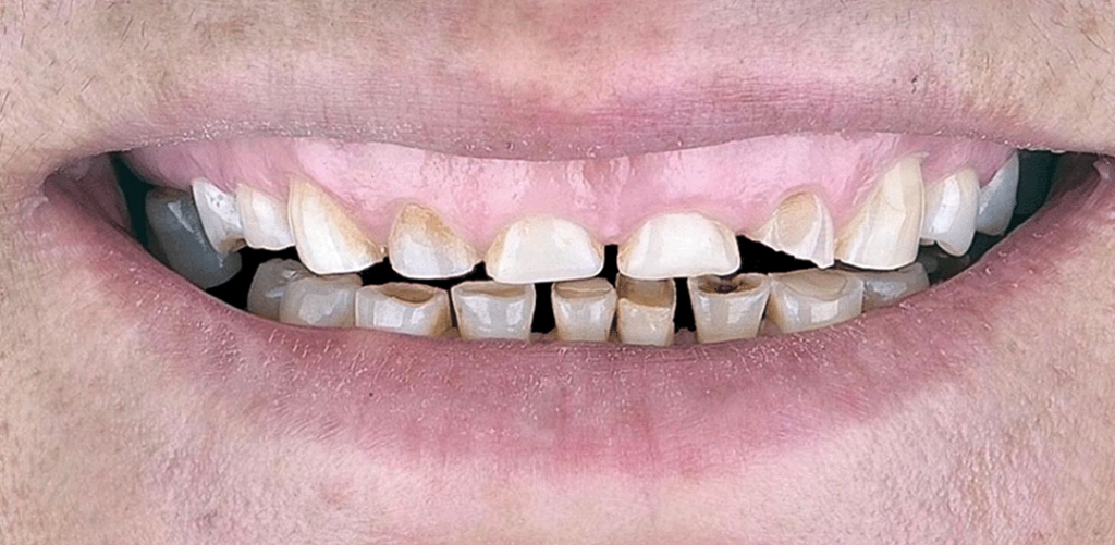 Sonrisa Antes